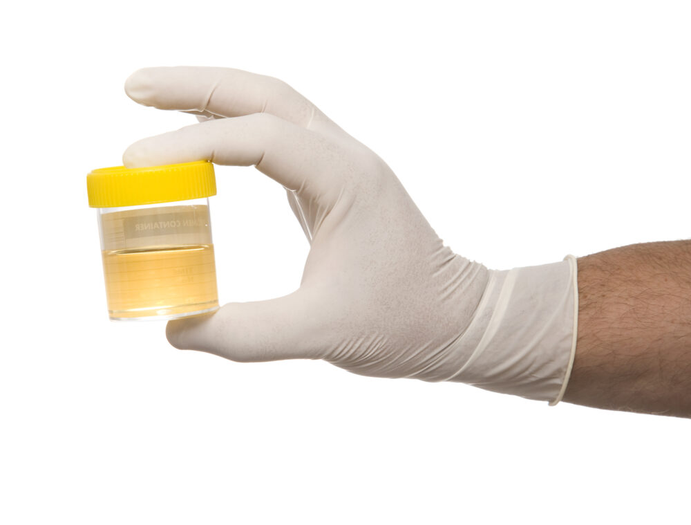 Lyme Borrelia Direct Detect (Urine)- Nano Trap - MosaicDx
